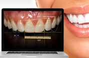 Digital Smile Design